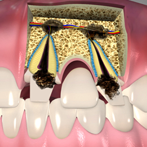 Endodontic Surgery